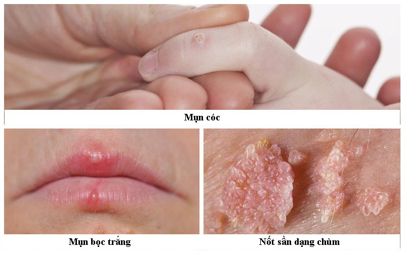 hậu quả của bệnh HPV